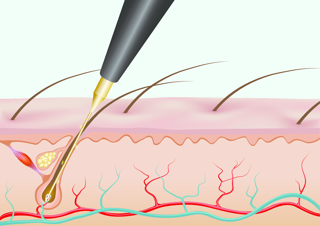 Electrolysis On Hair