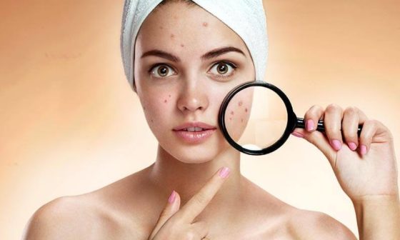 How To Prevent Pimples and Acne